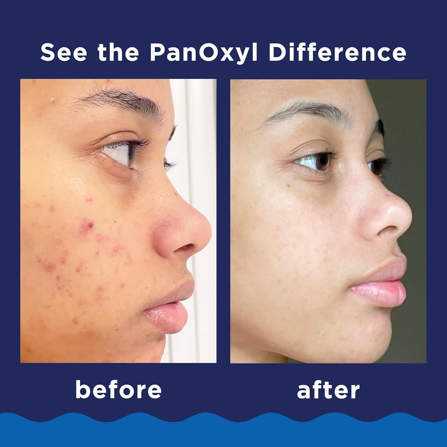 PanOxyl Acne Cleanser